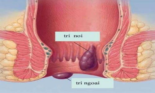 Với bài thuốc này, trĩ nội, trị ngoại đều khỏi hết