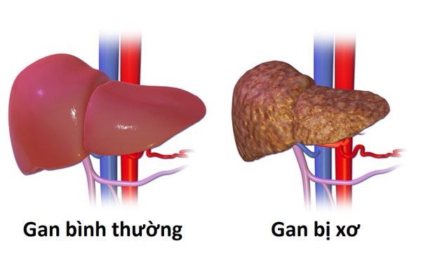 Chuyên gia chỉ điểm 5 kiểu người dễ ung thư gan, bạn có trong số đó?