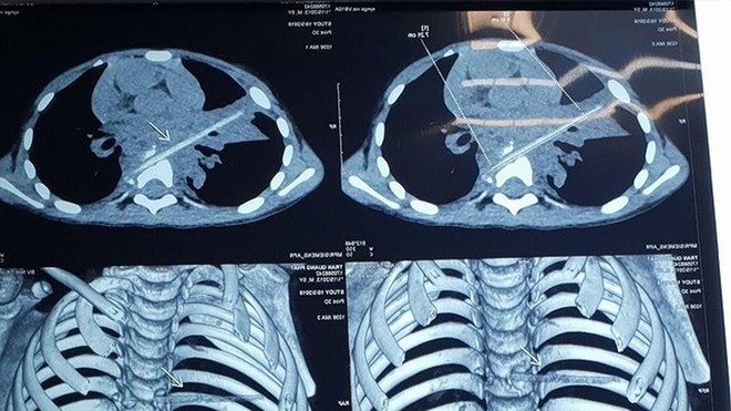 Bé 5 tuổi viêm phổi ròng rã 8 tháng liền: Thủ phạm là que xiên thịt nướng