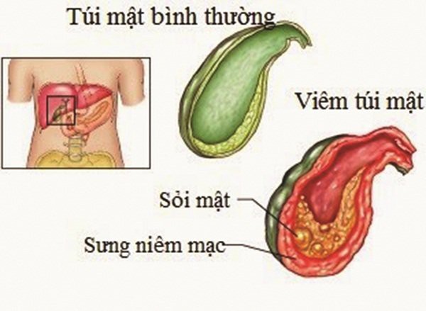 Nguyên nhân bé 9 tuổi đã bị sỏi mật khiến bố mẹ hết hồn