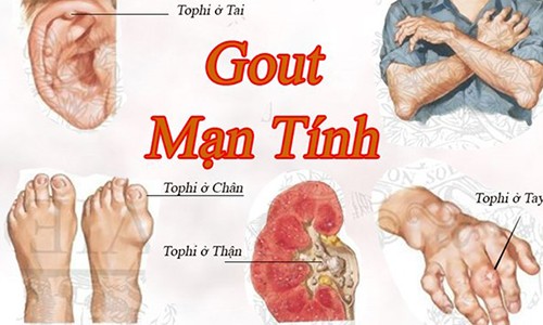 Kinh hoàng hình ảnh bệnh gout tàn phá cơ thể