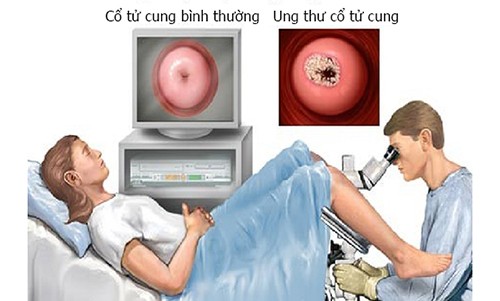 Dấu hiệu nhận biết sớm ung thư cổ tử cung