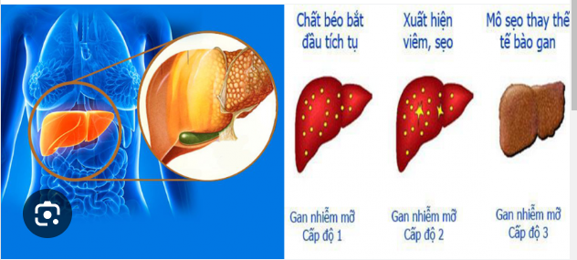 Cách giảm cả mỡ máu và gan nhiễm mỡ cùng 1 lúc