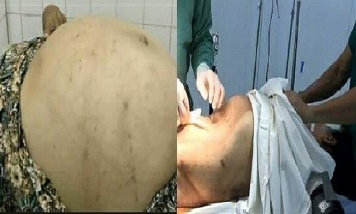 Tưởng béo bụng, đi khám mới phát hiện khối u gần 20kg