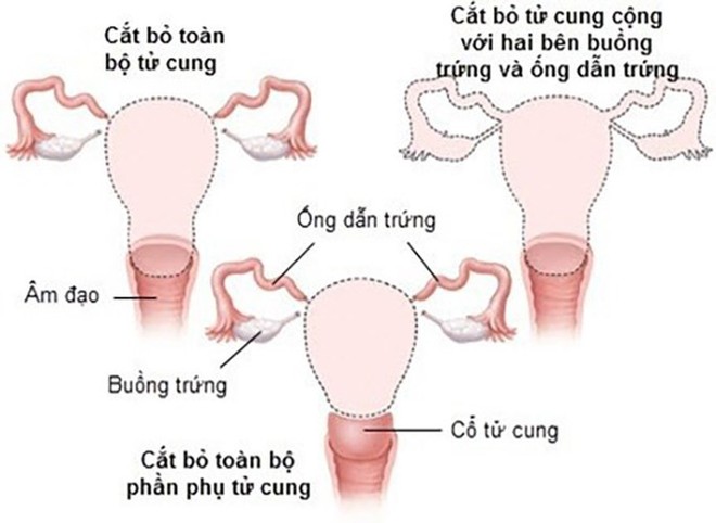 Cắt tử cung có ảnh hưởng chuyện phòng the?