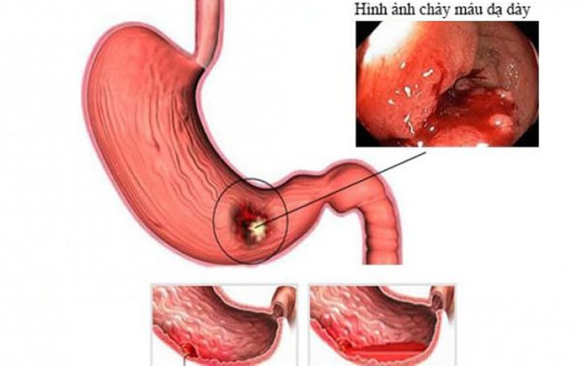 Sau một đêm không ngủ để làm điều này, vợ trẻ nôn ra máu phải cấp cứu