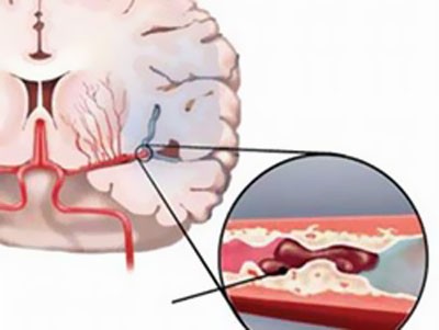 Đau nửa đầu vai gáy có phải thiếu máu não?