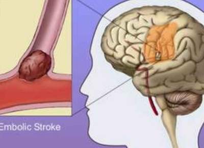 85% bệnh nhân bị thiếu máu não biến chứng và tử vong