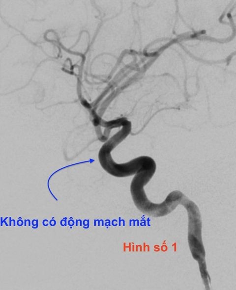 Bác sĩ phân tích rõ nguyên nhân tiêm filler thẩm mỹ lại mù mắt, đột quỵ? ảnh 2