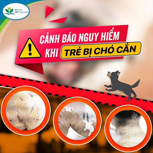 Trẻ bị 4 con chó tấn công với hàng trăm vết thương trên cơ thể