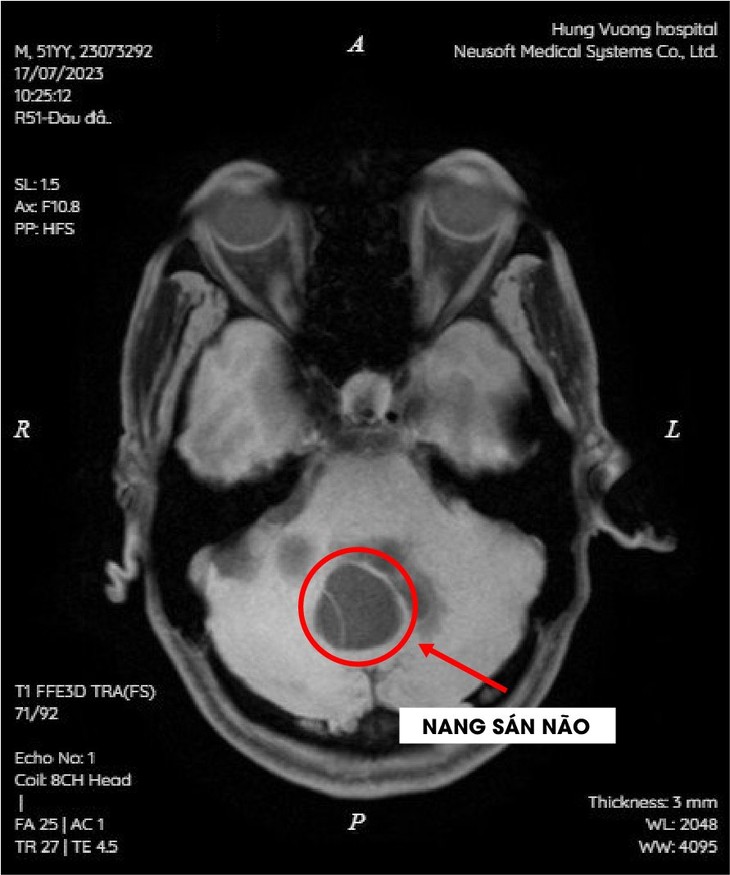 Thích ăn tiết canh, hai bệnh nhân bị nang sán trong não ảnh 1