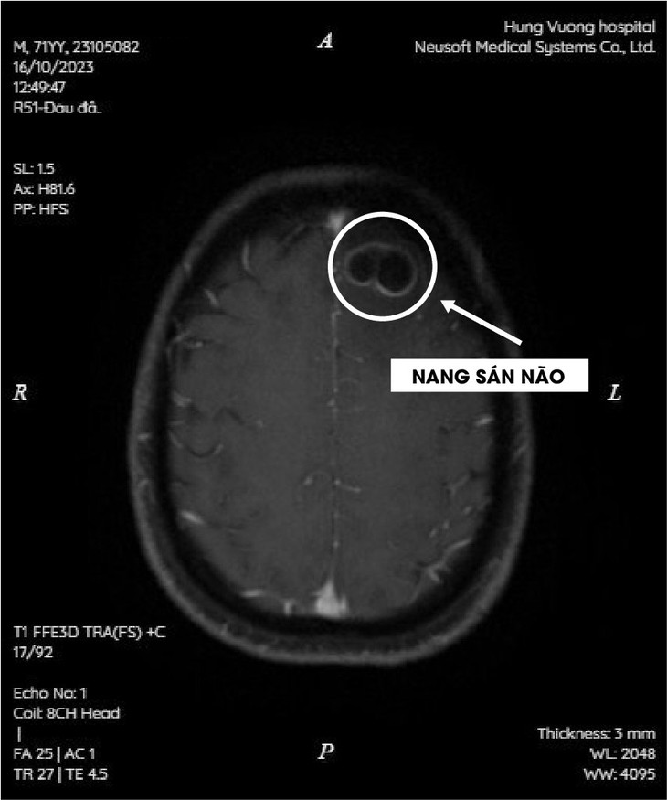 Thích ăn tiết canh, hai bệnh nhân bị nang sán trong não ảnh 2