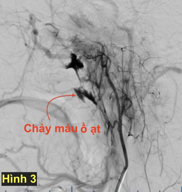 Chảy máu sau mổ nạo amidan vòm  ảnh 2