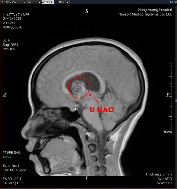 Đau âm ỉ vùng trán, cô gái 23 tuổi phát hiện khối u não nguy hiểm ảnh 1