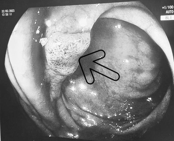 Sụt cân, ăn kém đi khám phát hiện 2 loại ung thư ảnh 2