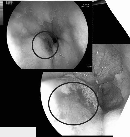 Sụt cân, ăn kém đi khám phát hiện 2 loại ung thư ảnh 3