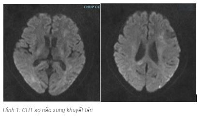 Tưởng đột quỵ, nào ngờ viêm não tự miễn thể hiếm gặp ảnh 1