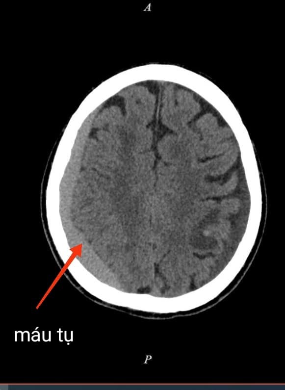 Sau tai nạn giao thông 2 tháng mới phát hiện tụ máu dưới màng cứng  ảnh 1