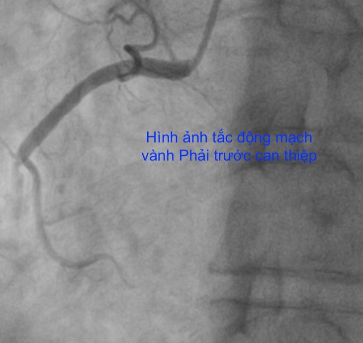 1 đêm 5 ca nhồi máu cơ tim, nhồi máu não: Phòng tránh thế nào? ảnh 1