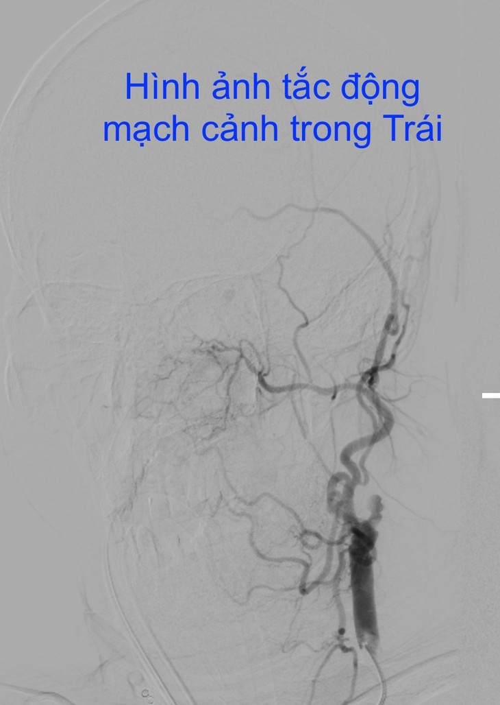 1 đêm 5 ca nhồi máu cơ tim, nhồi máu não: Phòng tránh thế nào? ảnh 4