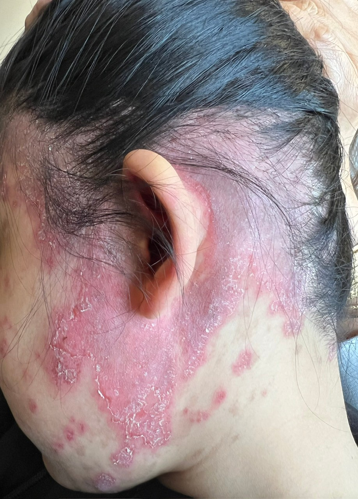 Tổn thương đa cơ quan vì Lupus ban đỏ ảnh 1