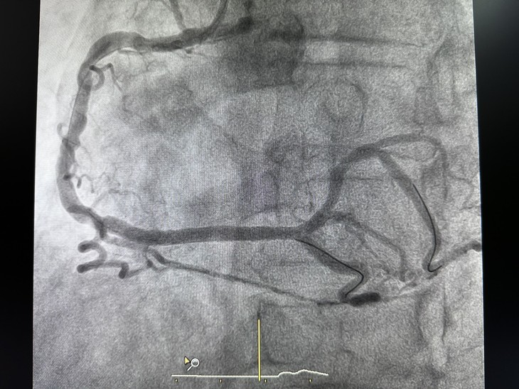 Nhồi máu cơ tim cấp vì bệnh 3 thân mạch vành ảnh 2