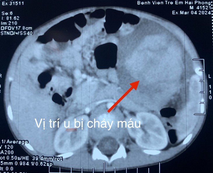 Mổ nội soi cắt bỏ u nang bạch huyết trong ổ bụng bé 41 tháng tuổi ảnh 2