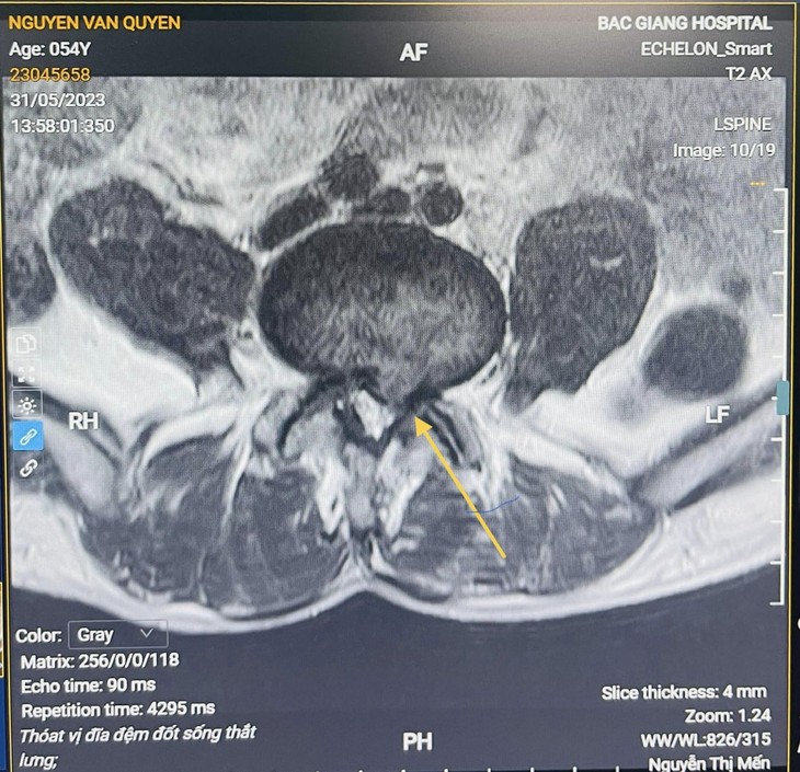 Suýt mất khả năng vận động vì thoát vị đĩa đệm lâu năm không phẫu thuật ảnh 2