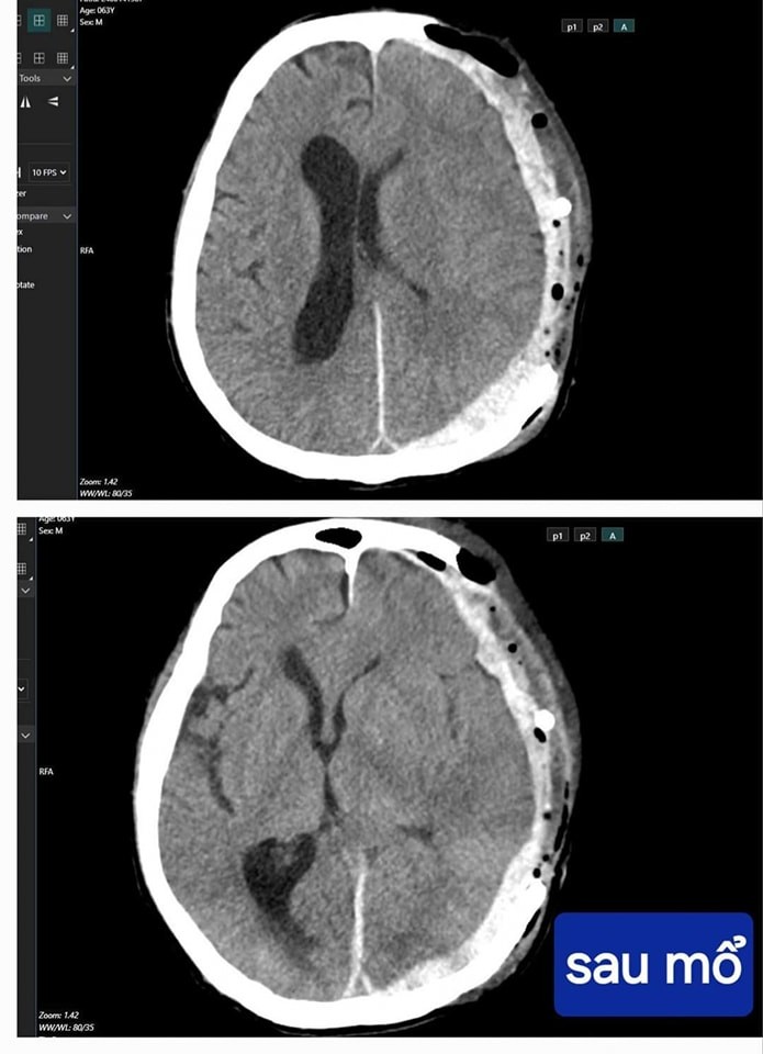 Cứu sống bệnh nhân bị tai nạn chấn thương sọ não, tiên lượng rất nặng ảnh 2