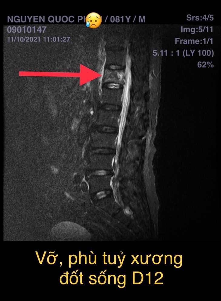 4. Điều trị và phục hồi