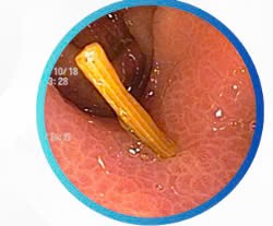 Hiểm họa khôn lường từ thói quen ngậm tăm tre ảnh 1