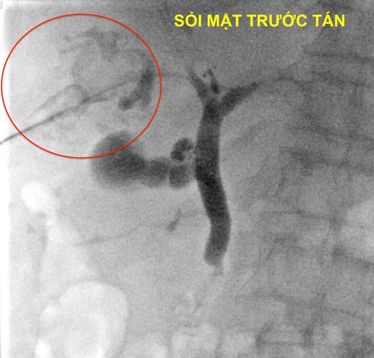 Tán sỏi mật qua da giúp bảo tồn mật ảnh 1