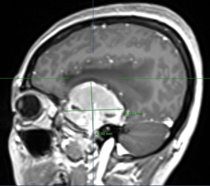 Đau đầu, bất ngờ phát hiện u màng não khổng lồ ăn sâu vào não ảnh 5
