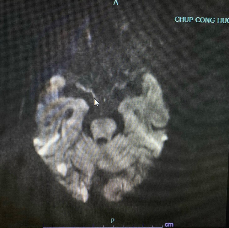 Chủ quan với chóng mặt, bệnh nhân bị đột quỵ, hôn mê ảnh 4