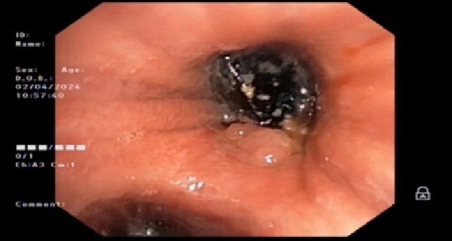 Ho, khó thở suốt 3 tháng mới phát hiện mắc hạt hồng xiêm trong phế quản ảnh 2