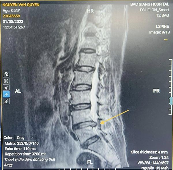 Suýt mất khả năng vận động vì thoát vị đĩa đệm lâu năm không phẫu thuật ảnh 1