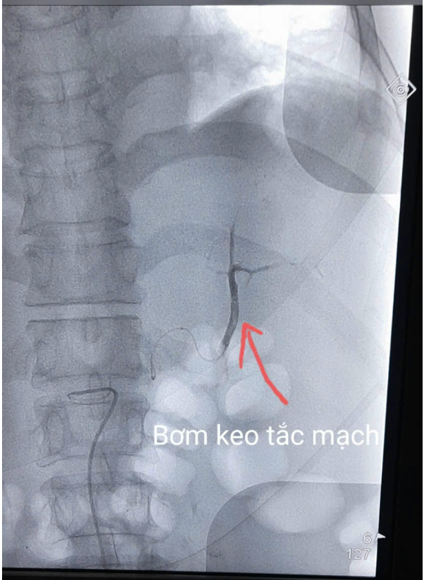 Chỉ định nút mạch, cấp cứu bệnh nhân vỡ lách thoát khỏi nguy kịch ảnh 3