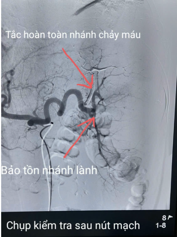 Chỉ định nút mạch, cấp cứu bệnh nhân vỡ lách thoát khỏi nguy kịch ảnh 4