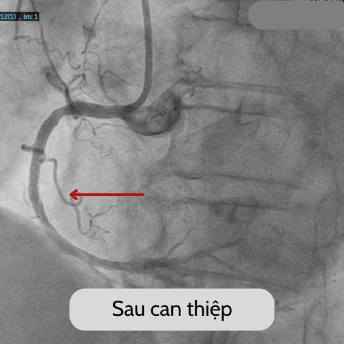 2 người đang khỏe thì... sốc tim do nhồi máu: Cách phát hiện sớm ảnh 4