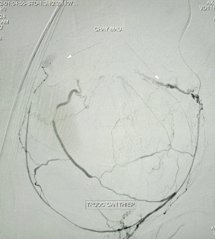 Cứu sản phụ bị băng huyết nguy kịch bằng kỹ thuật can thiệp nội mạch ảnh 3