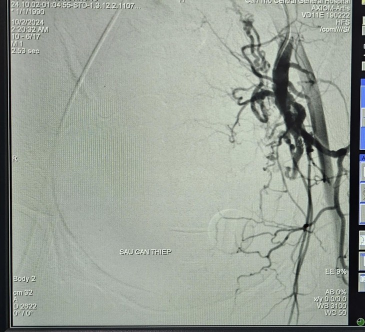 Cứu sản phụ bị băng huyết nguy kịch bằng kỹ thuật can thiệp nội mạch ảnh 4