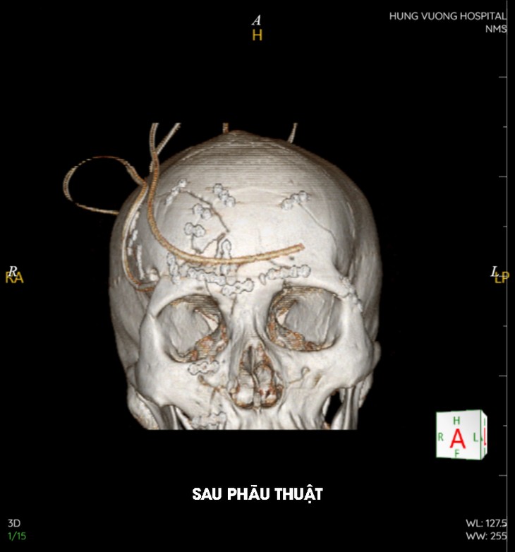 40 chiếc đinh vít tái tạo gương mặt bệnh nhân đa chấn thương sau tai nạn ảnh 2