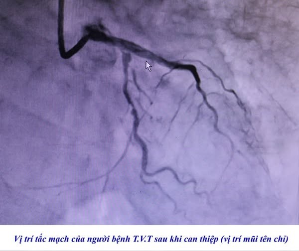 Đặt stent mạch vành cấp cứu cho 2 người bệnh gần 100 tuổi ảnh 2