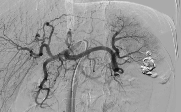 Nút mạch dưới hệ thống DSA cứu bệnh nhân sốc mất máy, vỡ lách độ IV ảnh 1