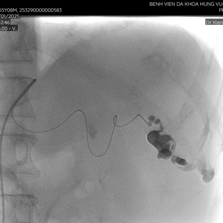 Nút mạch dưới hệ thống DSA cứu bệnh nhân sốc mất máy, vỡ lách độ IV ảnh 2