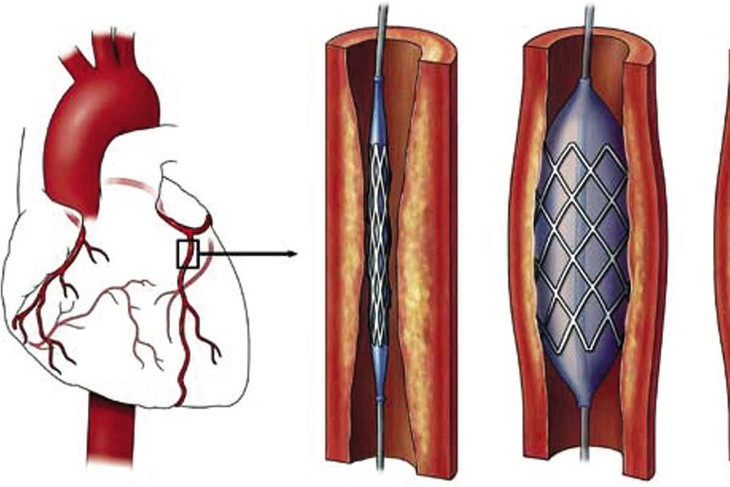 /Uploaded/khds.1cdn.vn/2018/09/16/dat-stent-nong-mach-vanh1.jpg