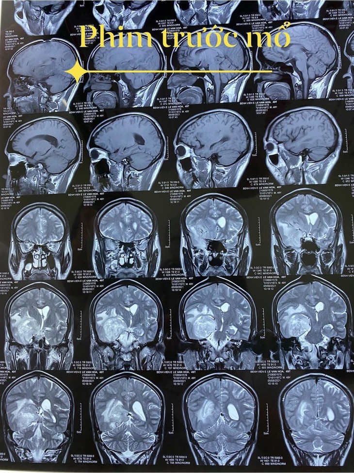 Khối u của bệnh nhân trên phim trước mổ. u-nao-khong-lo-1.jpg