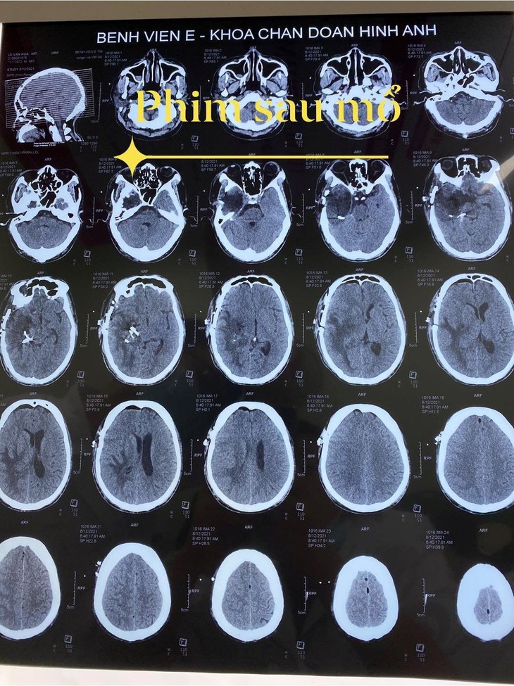 Khối u đã được lấy hết sau mổ. u-nao-khong-lo-2.jpg