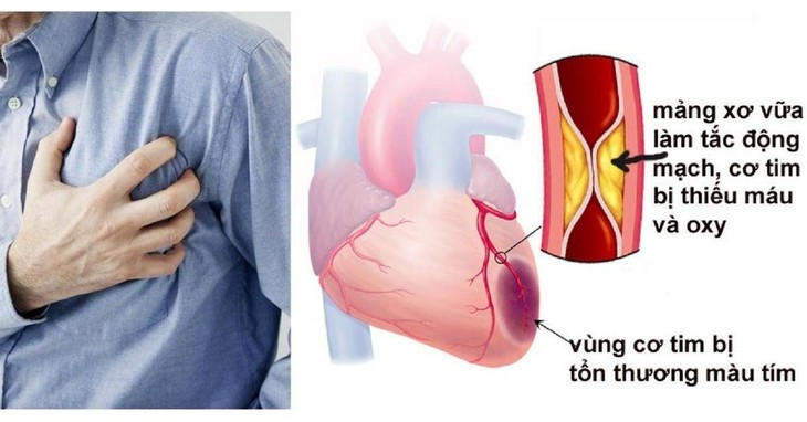 Đau thắt ngực cần được điều trị kiểm soát để tránh tai biến dau-that-nguc-on-dinh.jpg