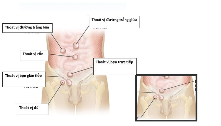 Thoát vị bẹn thoat-vi-ben-va-nang-nuoc.png